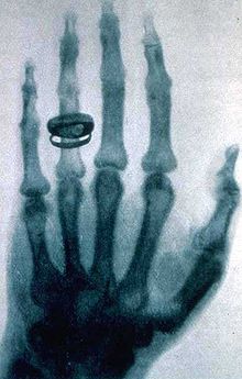 Name:  220px-Roentgen-x-ray-von-kollikers-hand.jpg
Views: 385
Size:  18.3 KB